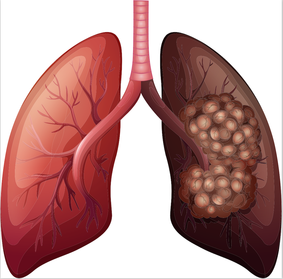 Lung cancer treatment
