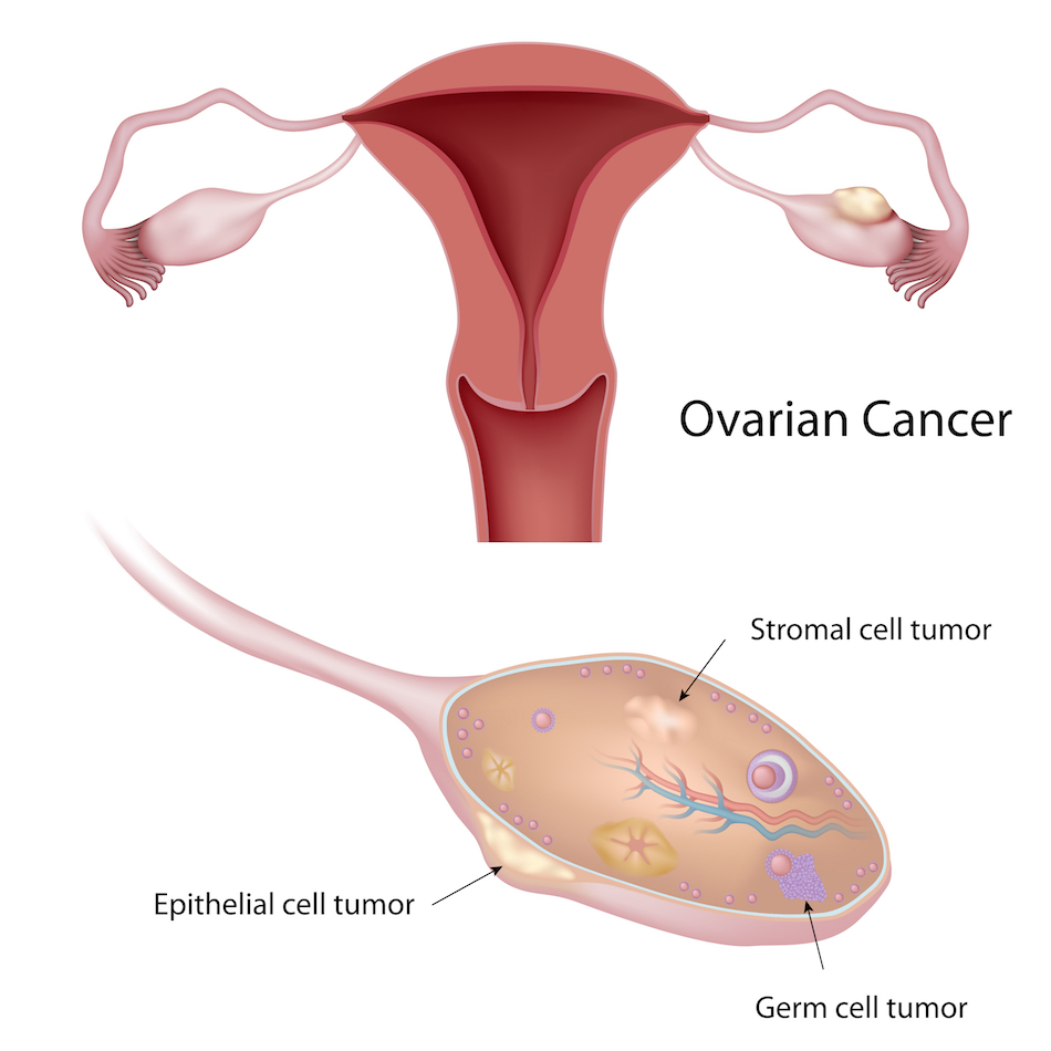 Traitement Cancer de l'ovaire