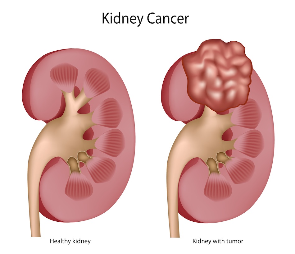 Kidney cancer treatment