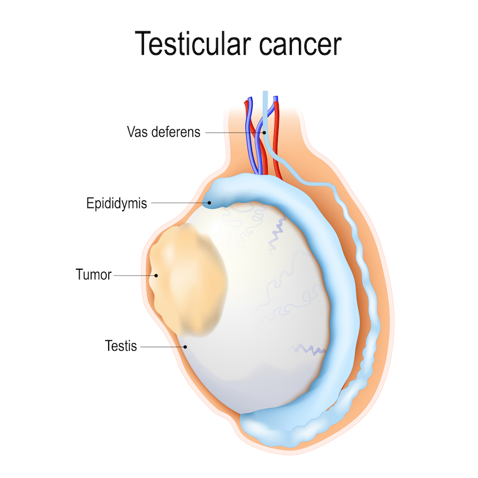 Testicular cancer treatment