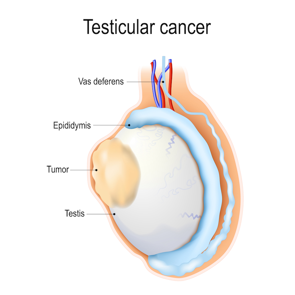 Traitement Cancer des testicules - Medicaim.com