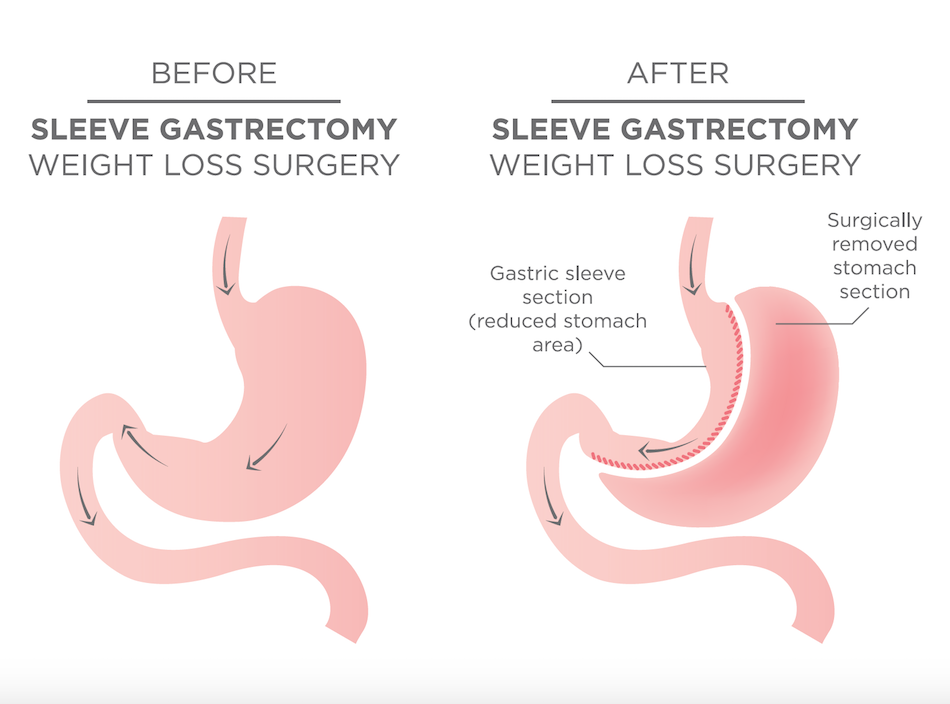 Procedure - Sleeve gastrectomy