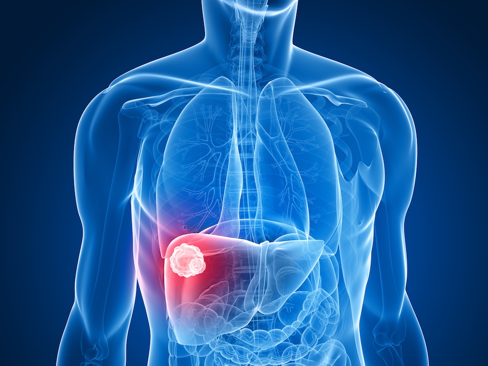 Liver cancer treatment