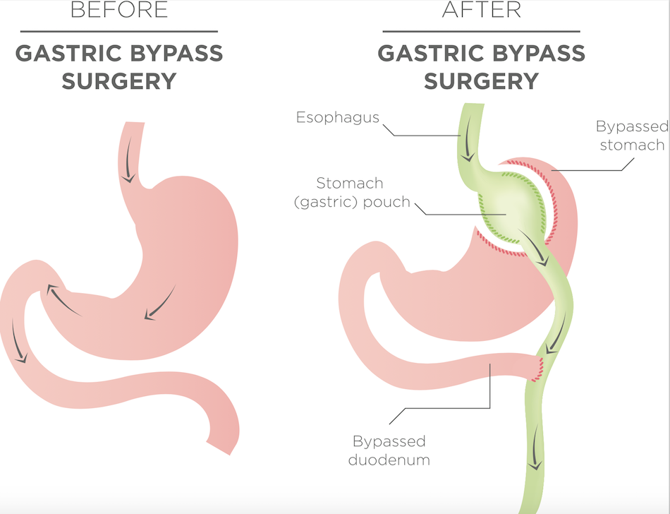 Gastric bypass operation