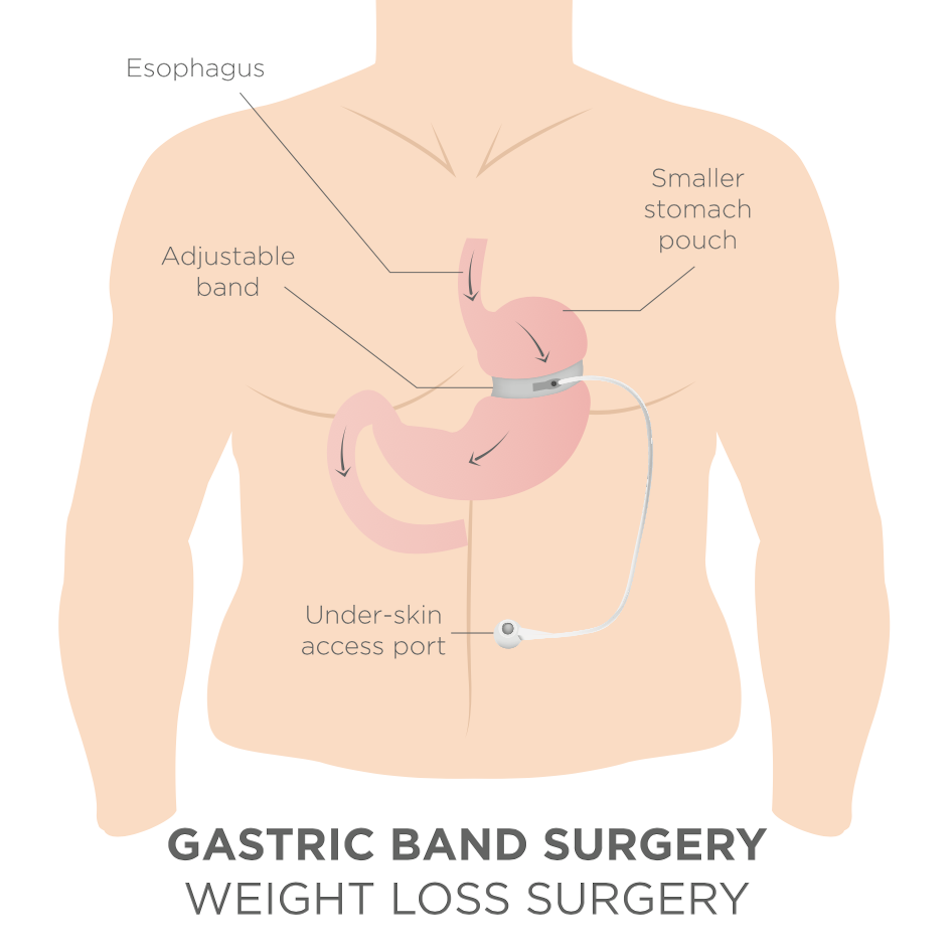 Installation of a gastric ring