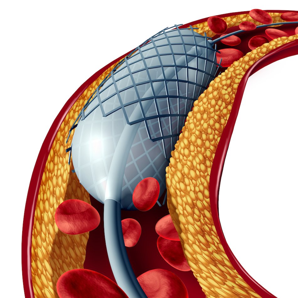 Angioplastie