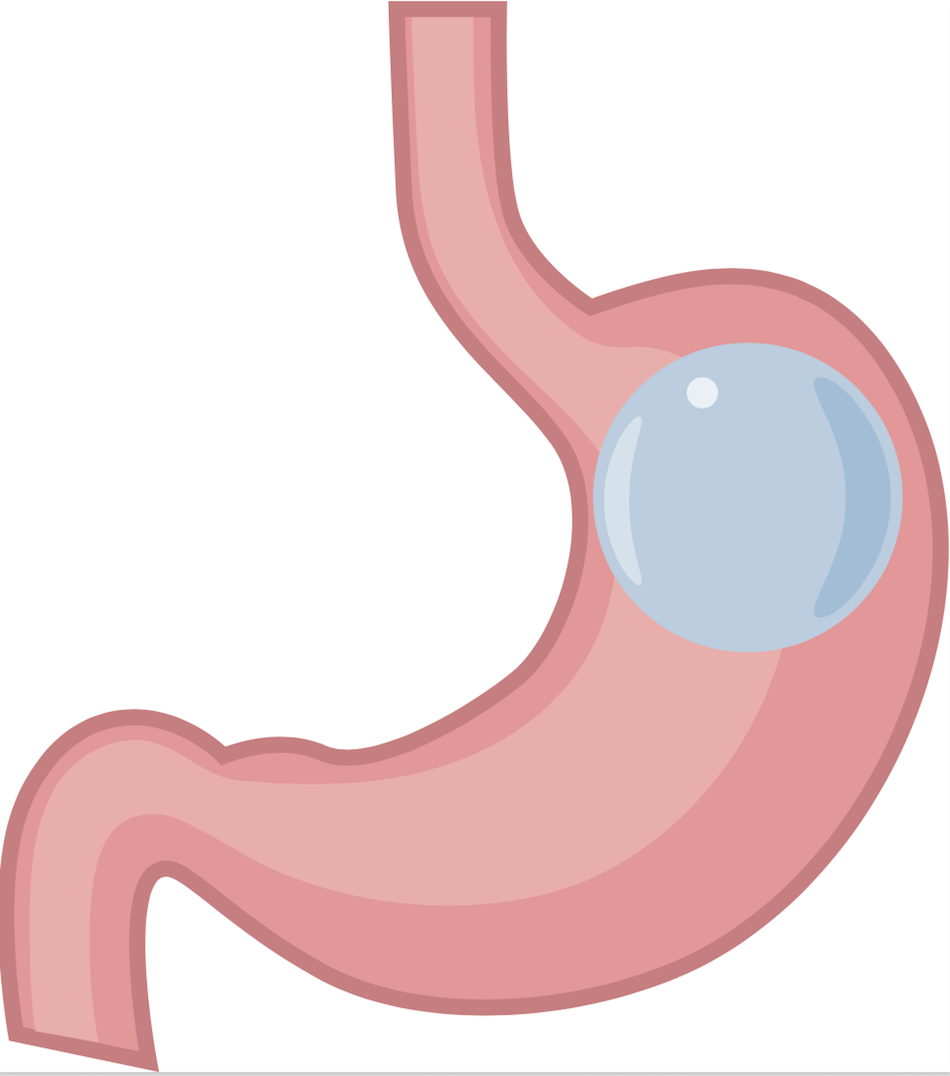 Intragastric balloon