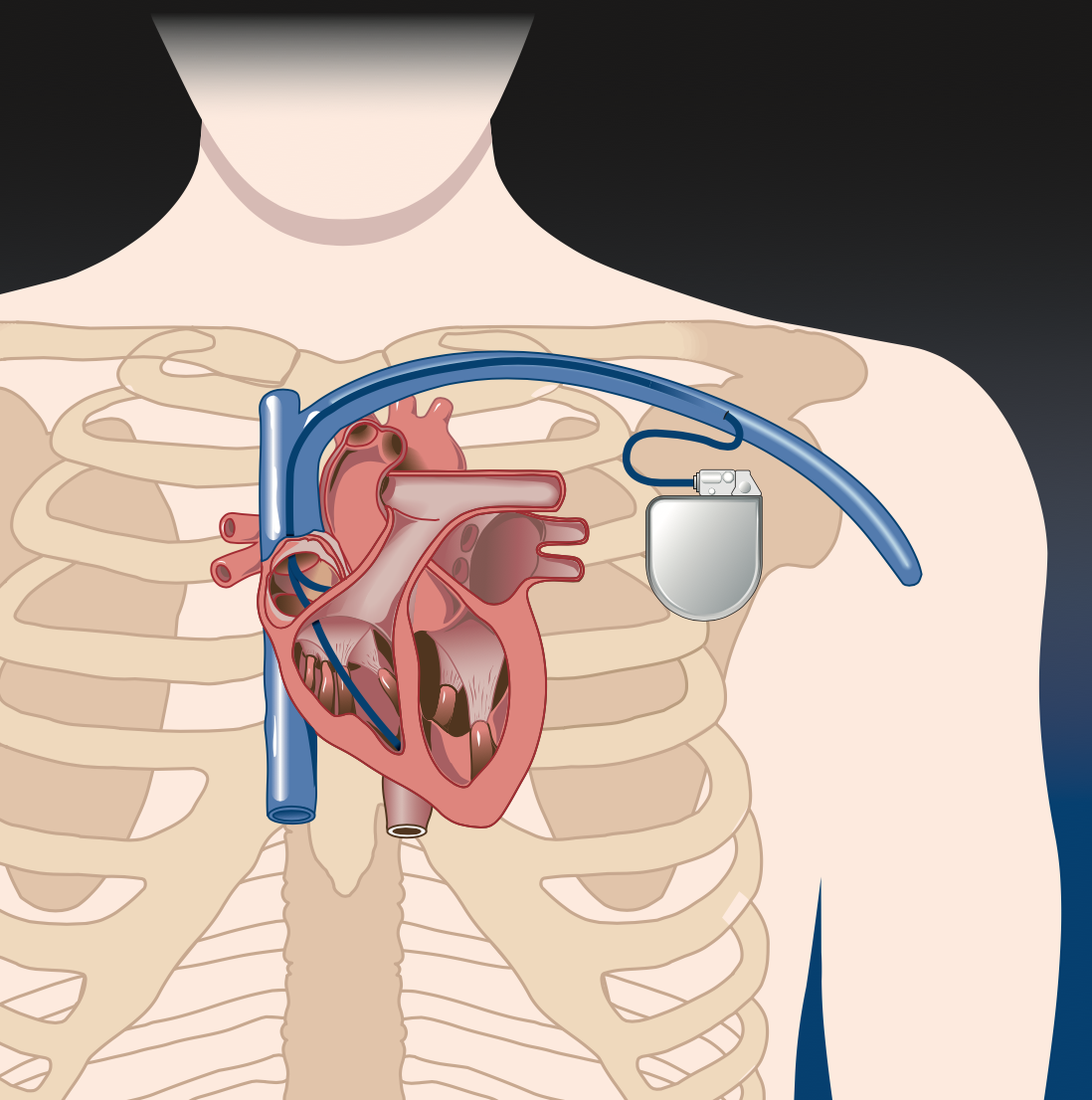 Cardiac Resynchronization Therapy (CRT)