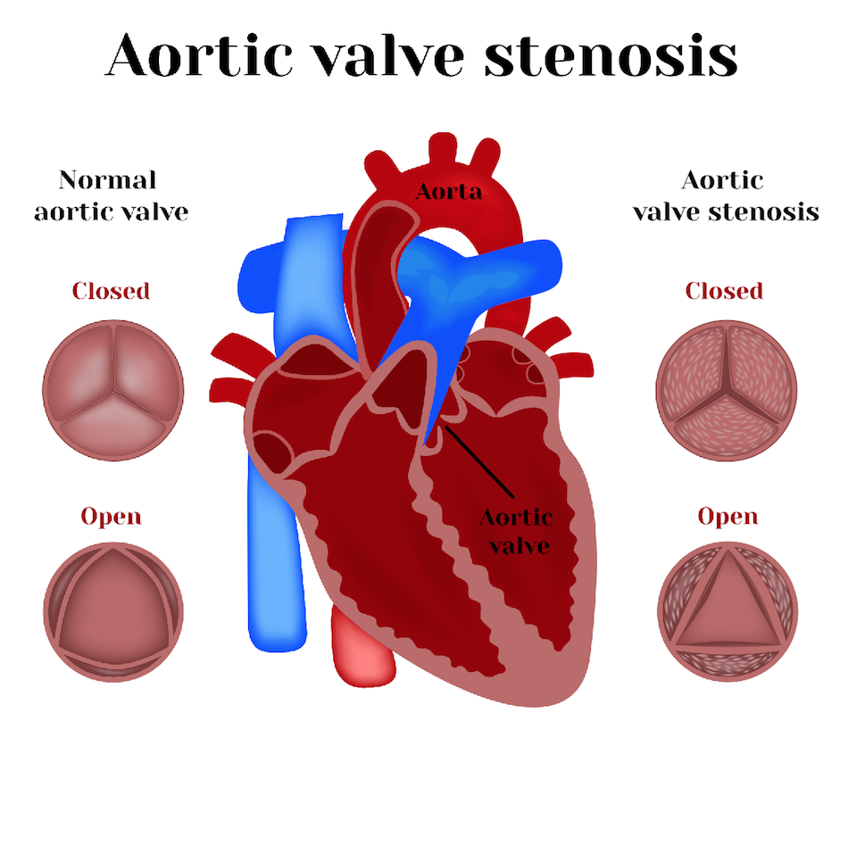 Aortic Valve Replacement (AVDR)