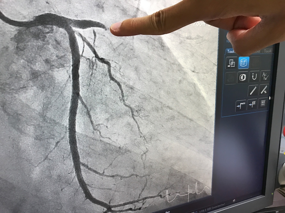 Coronary angiography