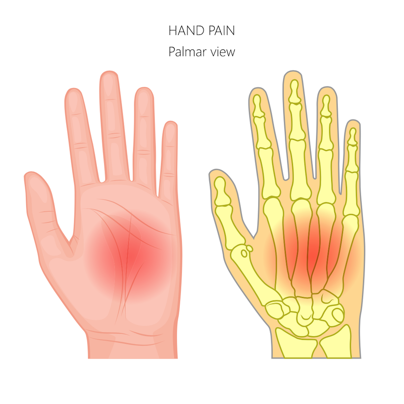 Carpal tunnel syndrome