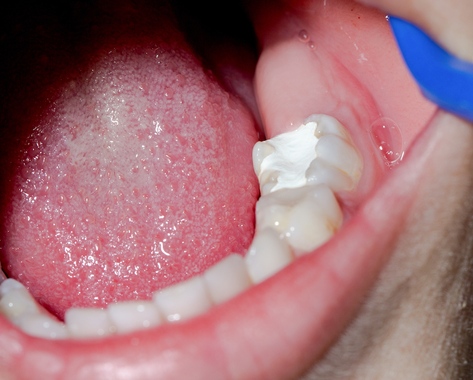 Dental filling