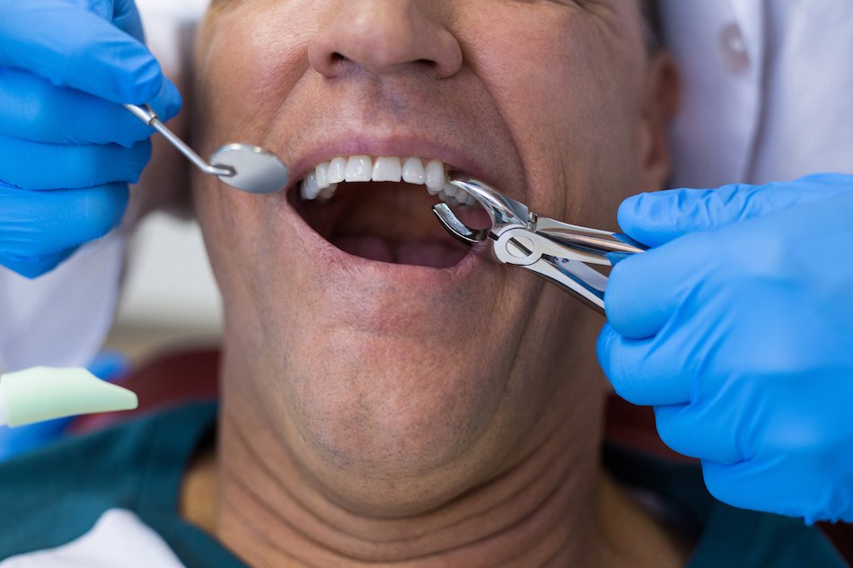 Dental extraction