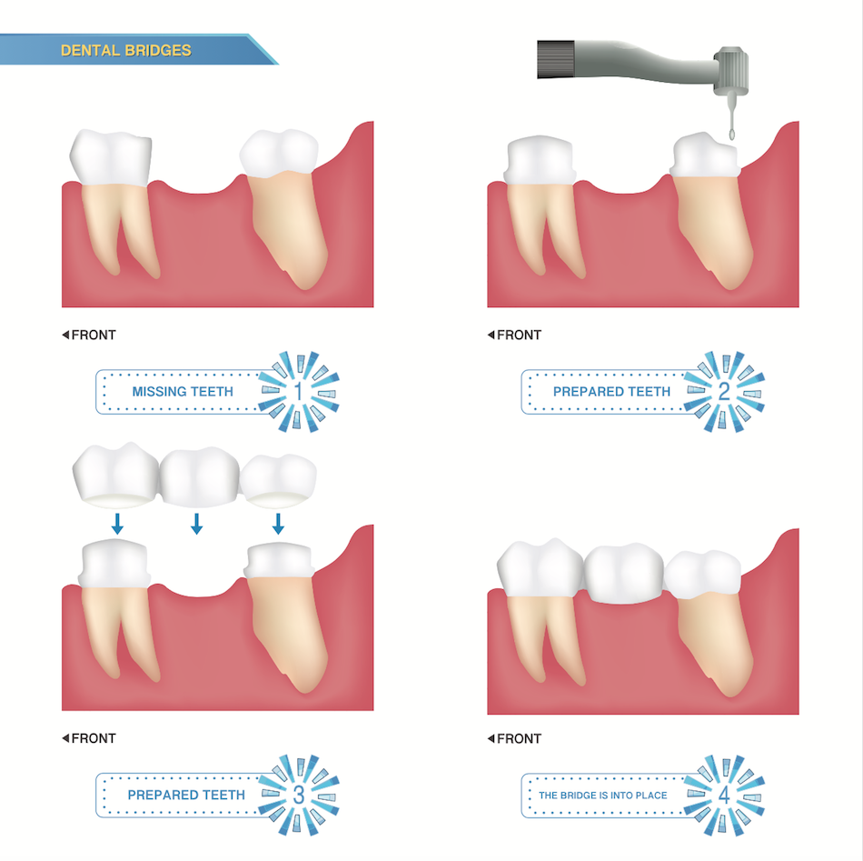 Dental bridge