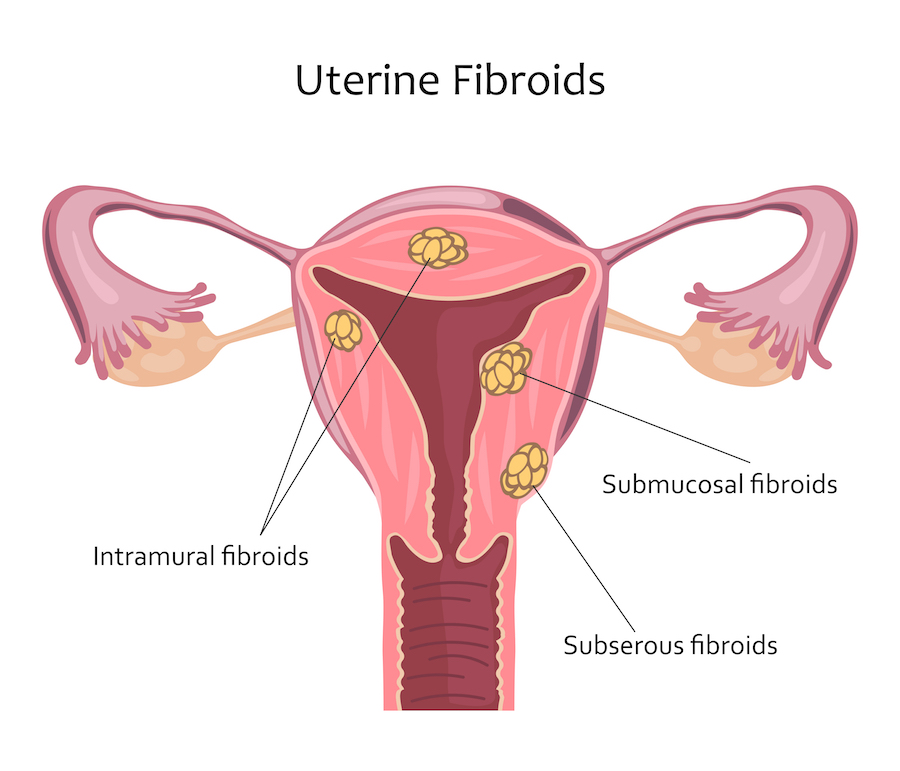 Fibrome utérin - Medicaim.com